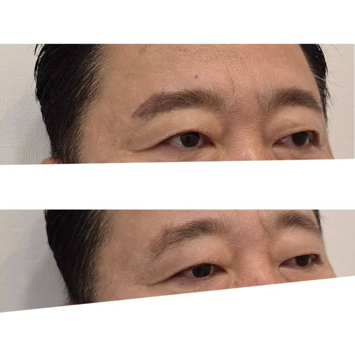 남자눈썹 실제 시술 사례
