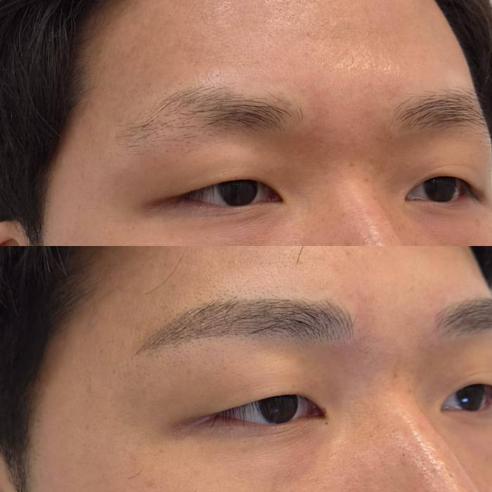 남자눈썹 콤보눈썹 실제 시술 사례