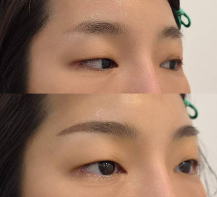 여자눈썹 실제 시술 사례