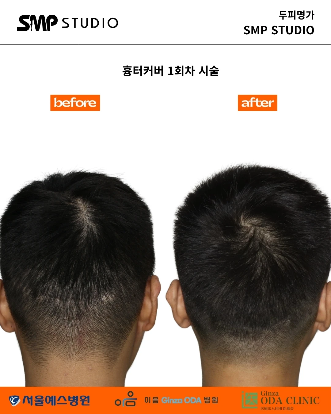 두피 흉터 커버 SMP 실제 전후 원본 기록